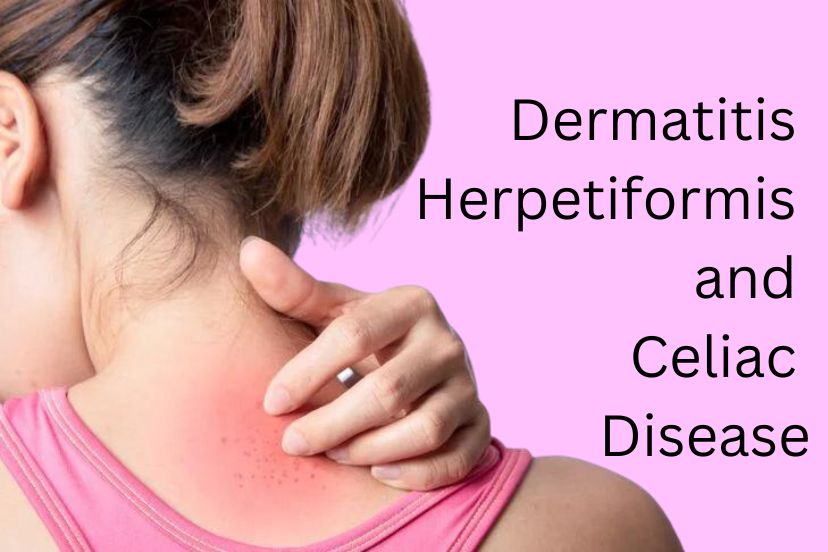 Dermatitis Herpetiformis and Celiac Disease