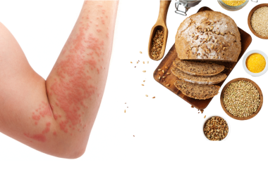 lupus and gluten intolerance